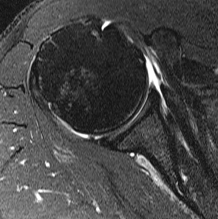 MRI Retracted Subscapularis Tear
